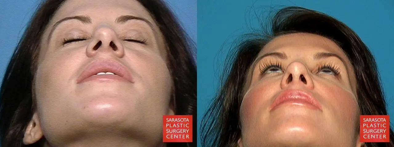 Rhinoplasty: Patient 10 - Before and After 6
