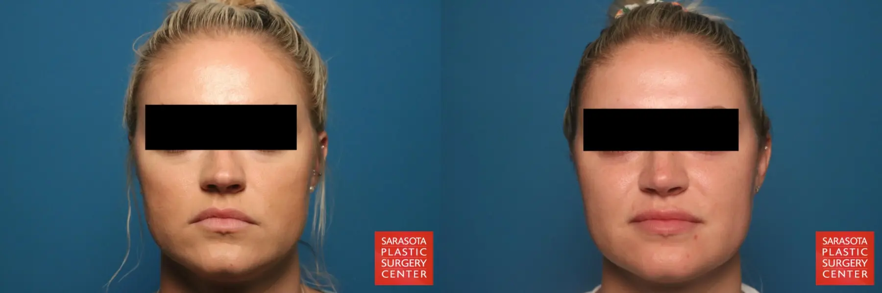 Rhinoplasty: Patient 8 - Before and After  