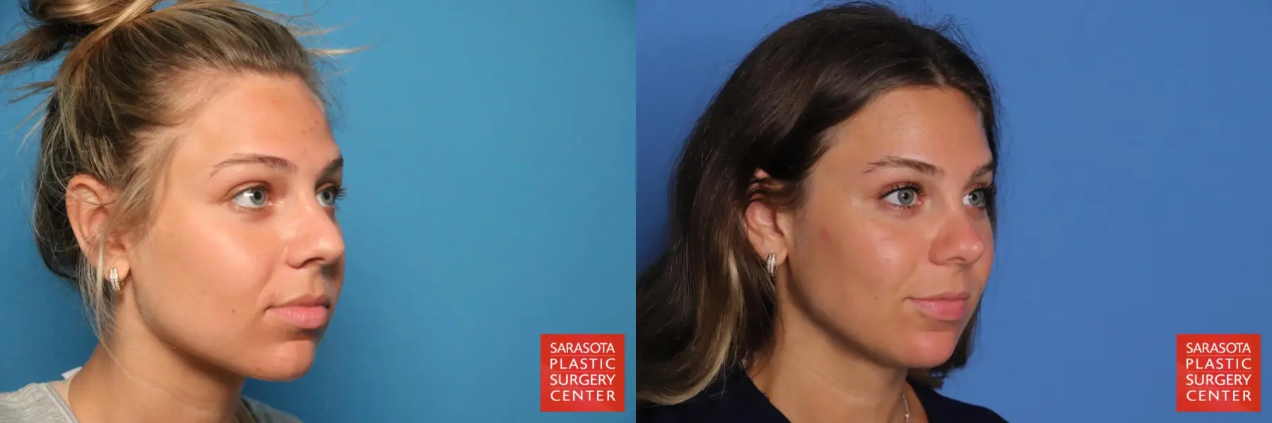 Rhinoplasty: Patient 33 - Before and After 4