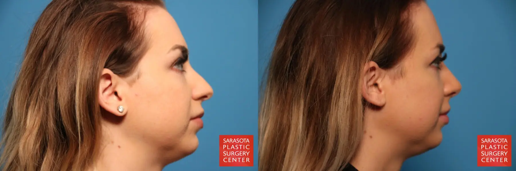 Rhinoplasty: Patient 3 - Before and After 6