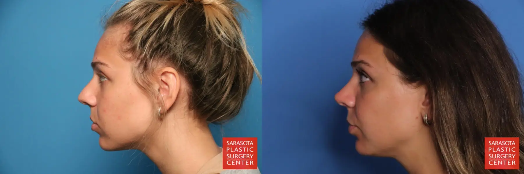 Rhinoplasty: Patient 33 - Before and After 3