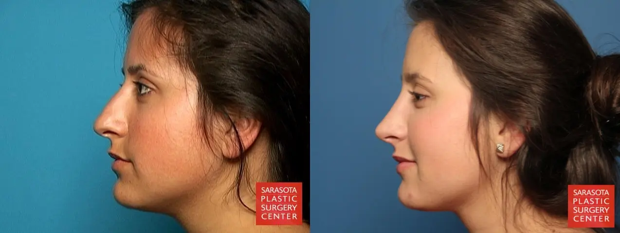 Rhinoplasty: Patient 1 - Before and After 3