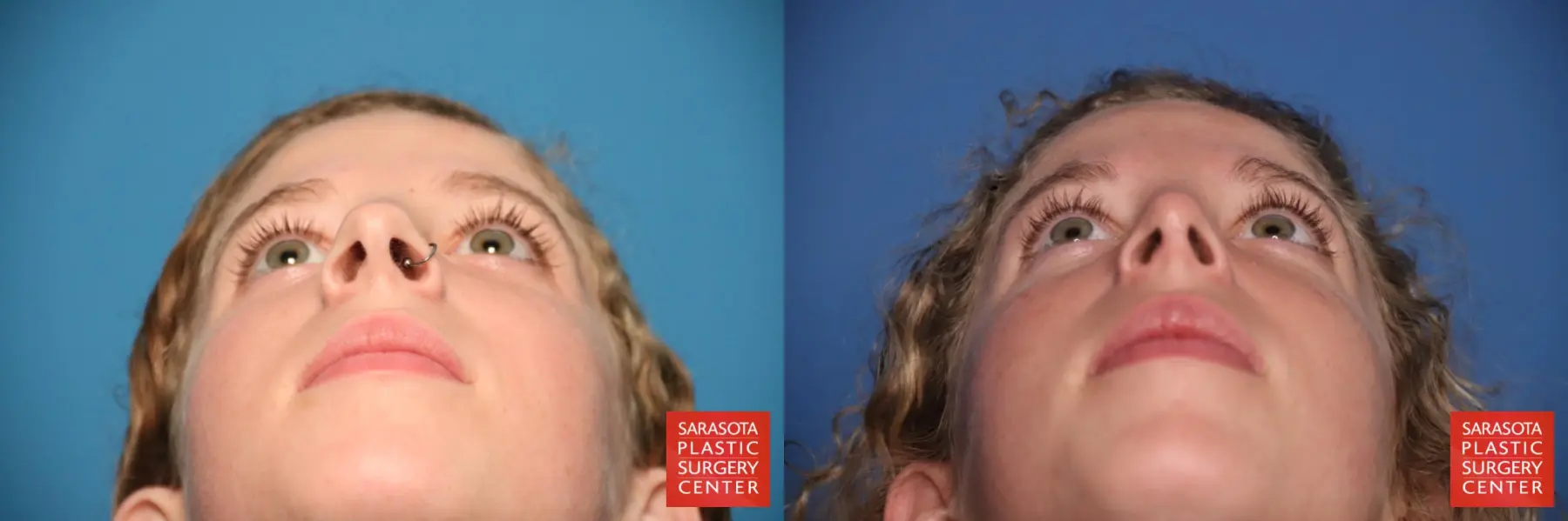 Rhinoplasty: Patient 7 - Before and After 6