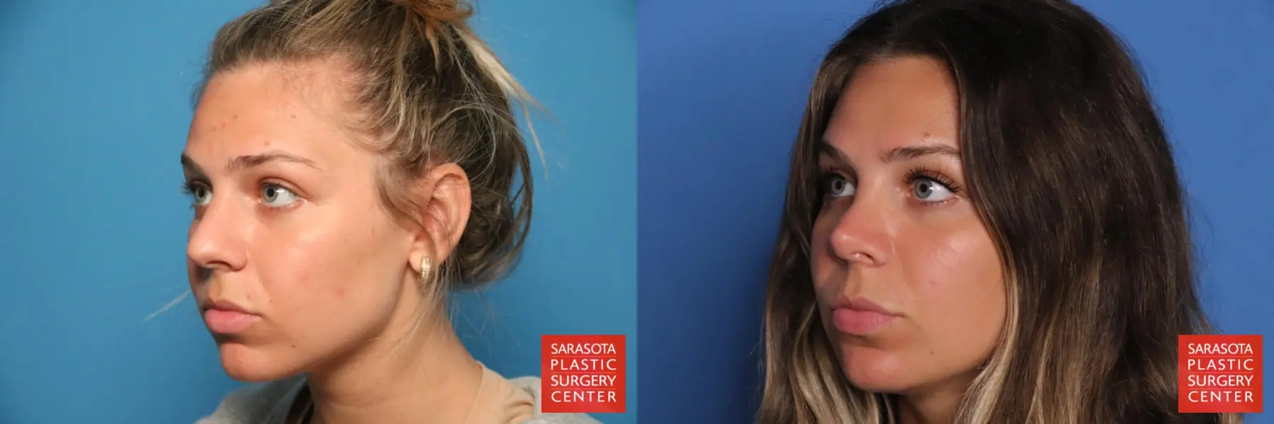 Rhinoplasty: Patient 33 - Before and After 2