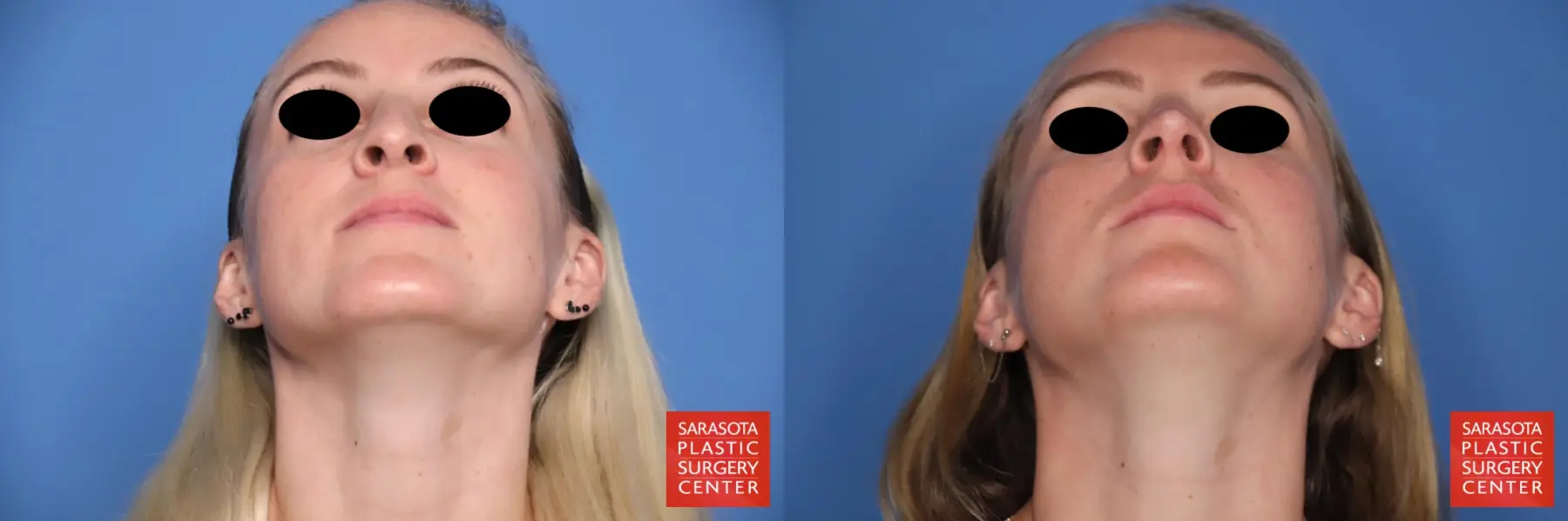 Rhinoplasty: Patient 11 - Before and After 6