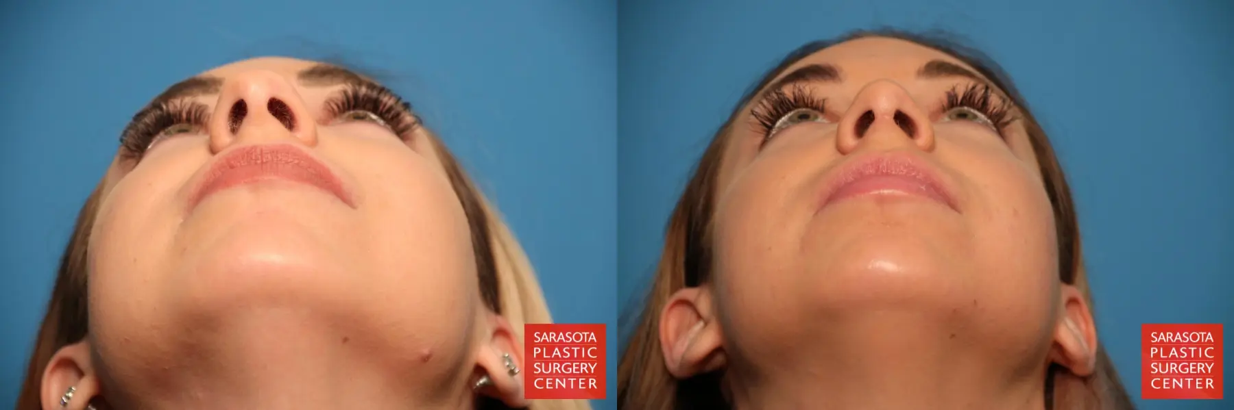 Rhinoplasty: Patient 5 - Before and After 2
