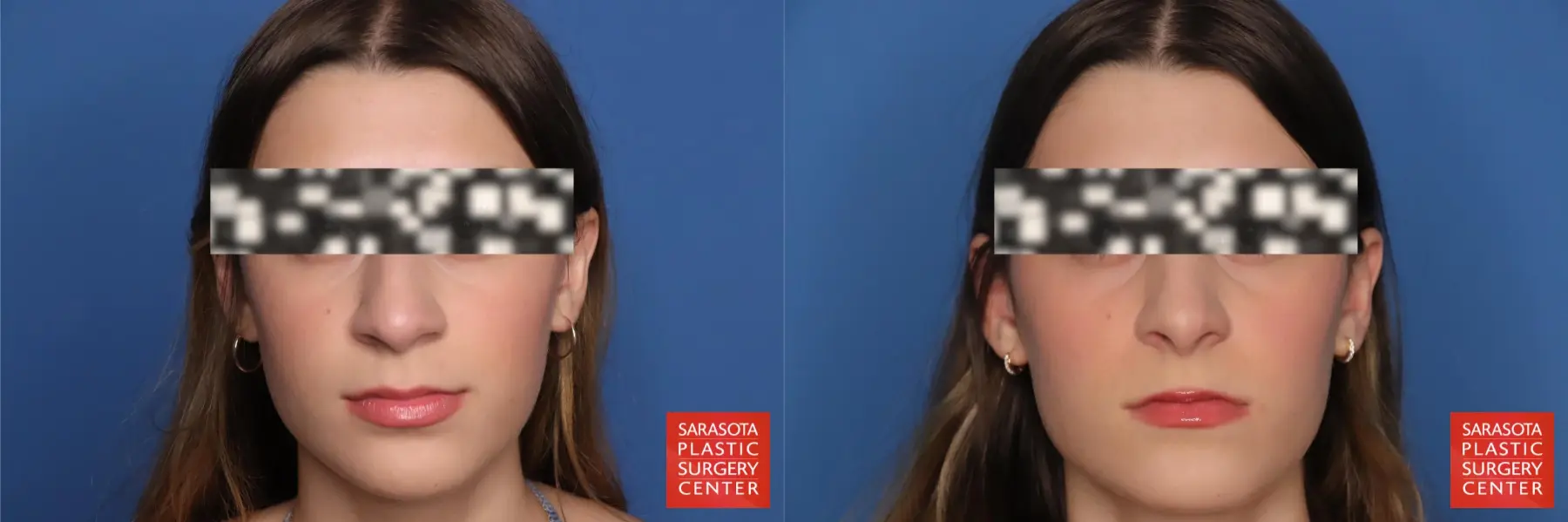 Rhinoplasty: Patient 24 - Before and After  