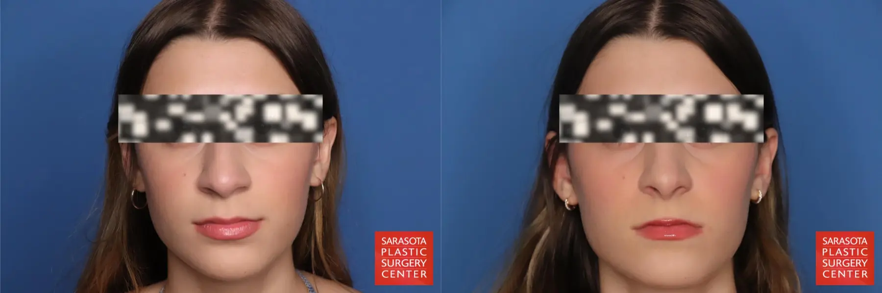 Rhinoplasty: Patient 23 - Before and After  