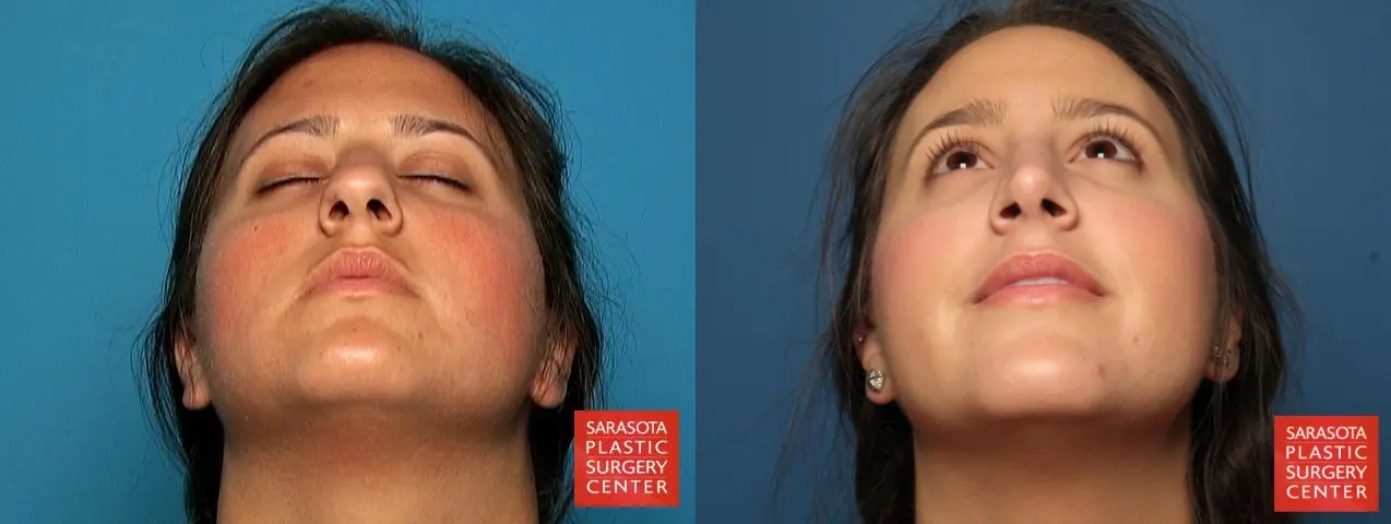 Rhinoplasty: Patient 1 - Before and After 4