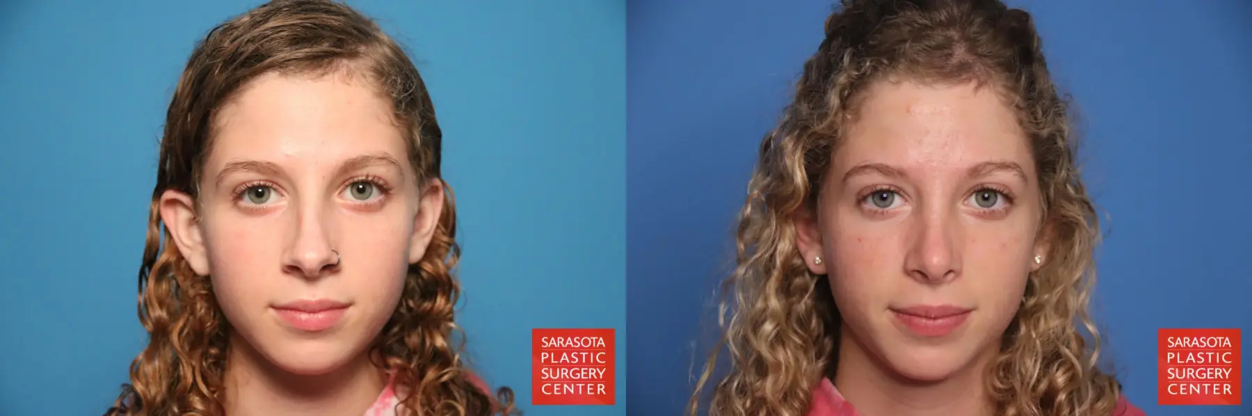 Rhinoplasty: Patient 7 - Before and After 1