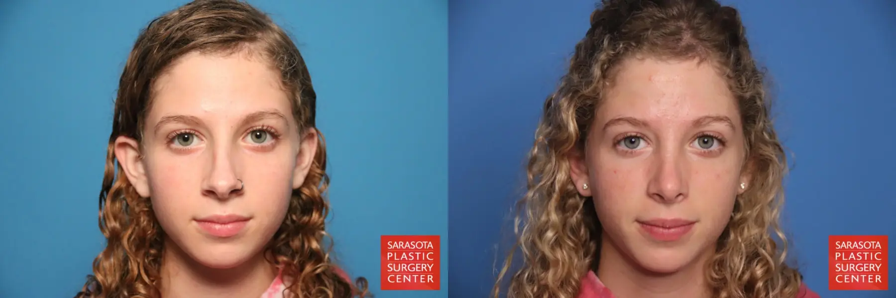 Rhinoplasty: Patient 7 - Before and After  