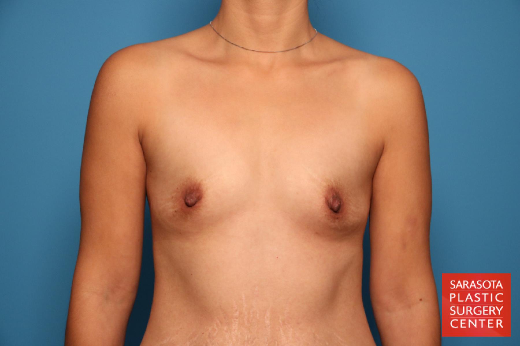 Breast Augmentation: Patient 25 - Before 1