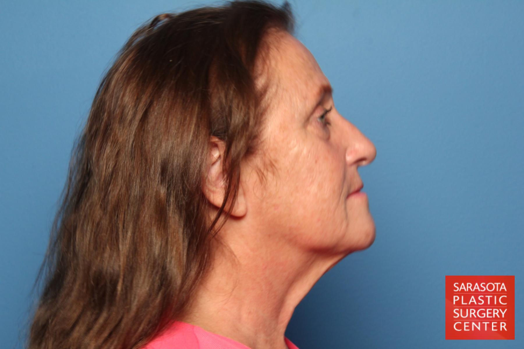 Facelift: Patient 15 - Before and After 3