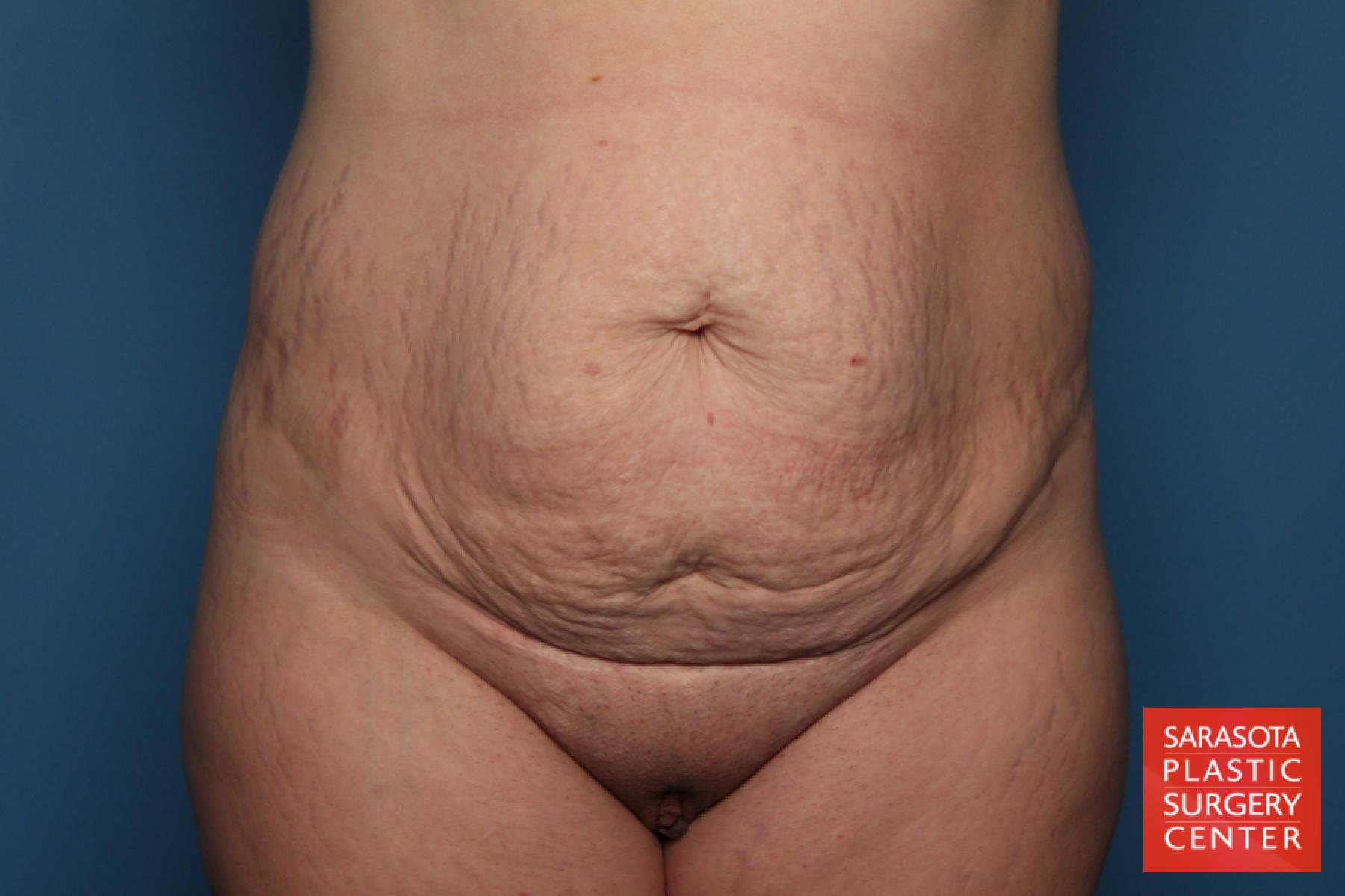 Tummy Tuck: Patient 21 - Before 1