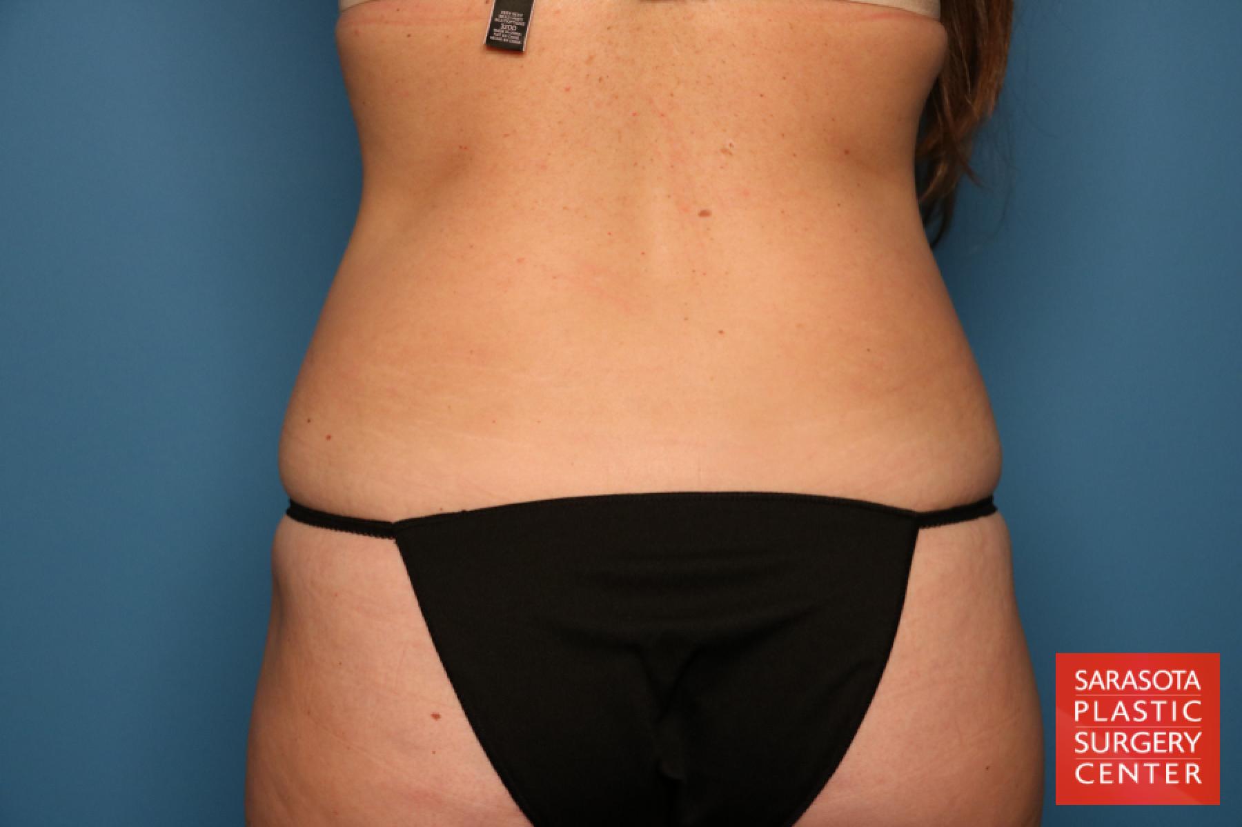 Liposuction: Patient 4 - After 6