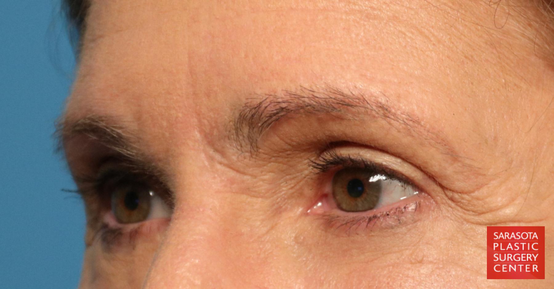 Eyelid Lift: Patient 28 - After 2