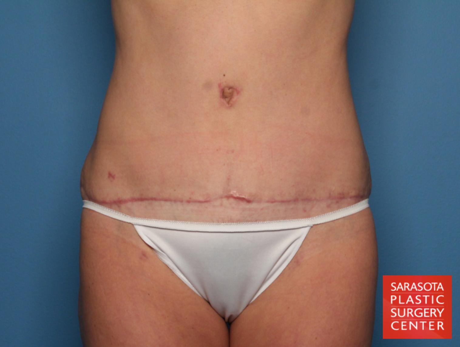 Tummy Tuck: Patient 20 - After 1