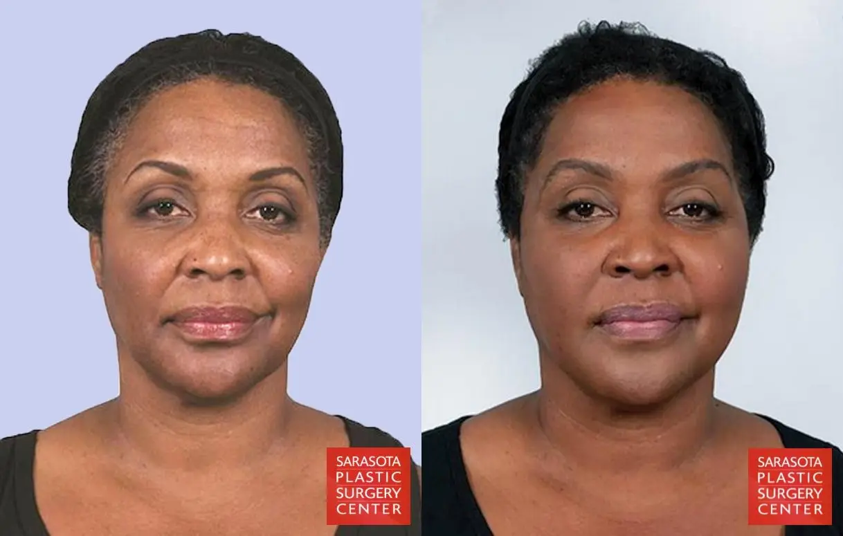 Sculptra®: Patient 2 - Before and After  