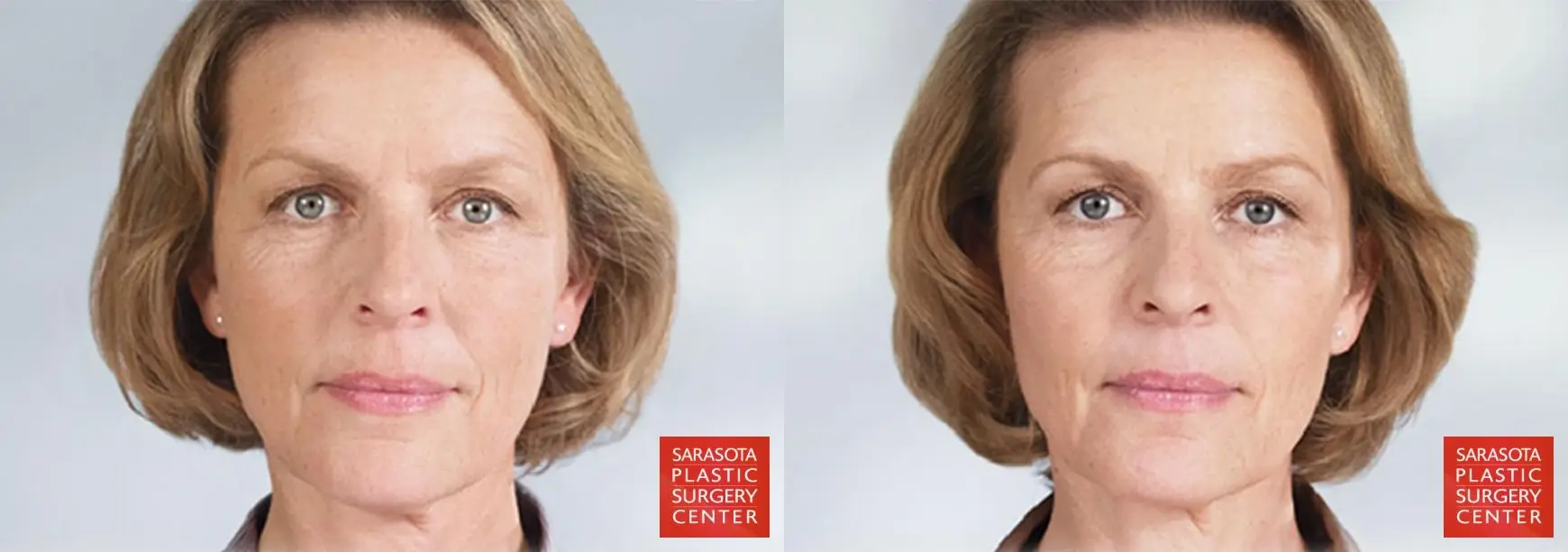 Sculptra®: Patient 1 - Before and After 2