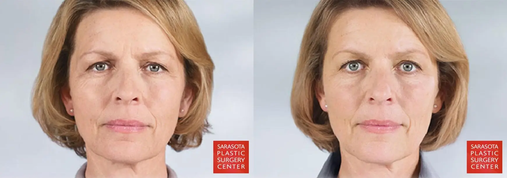 Sculptra®: Patient 1 - Before and After 1