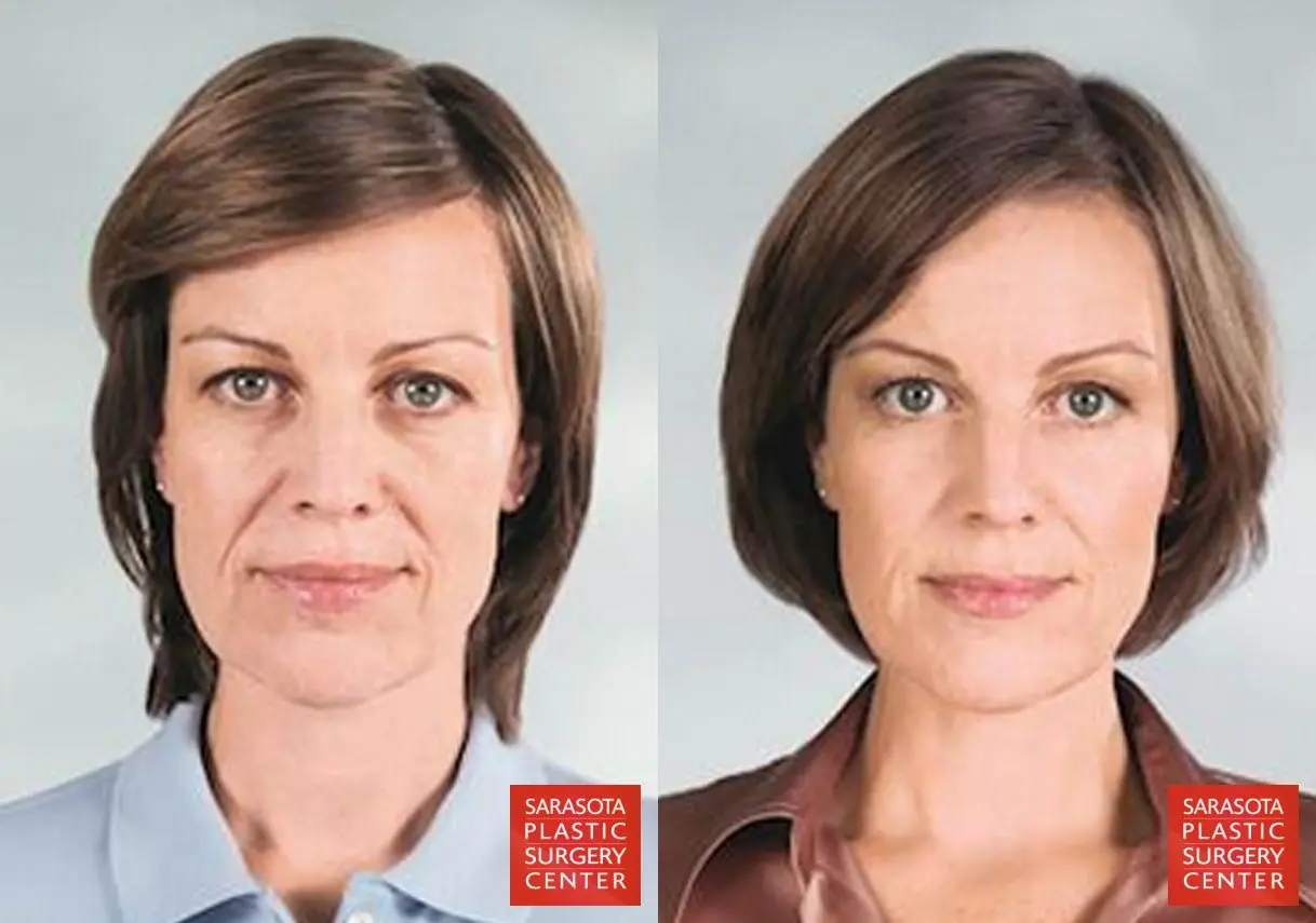 Sculptra®: Patient 3 - Before and After  