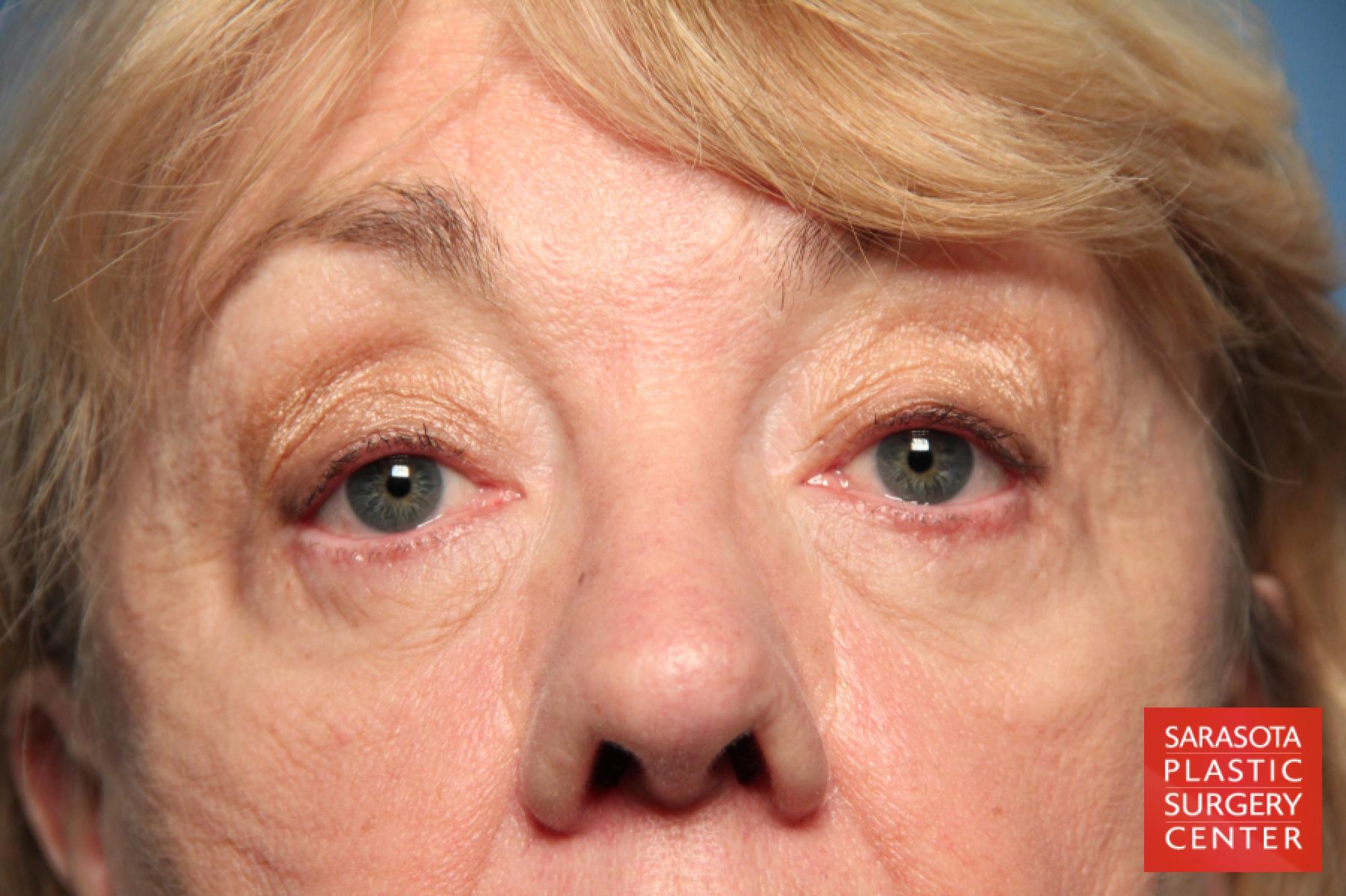 Eyelid Lift: Patient 23 - Before 1