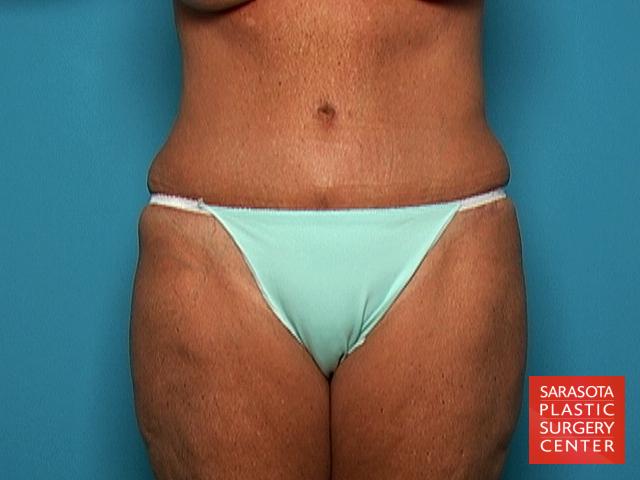 Tummy Tuck: Patient 3 - After 1