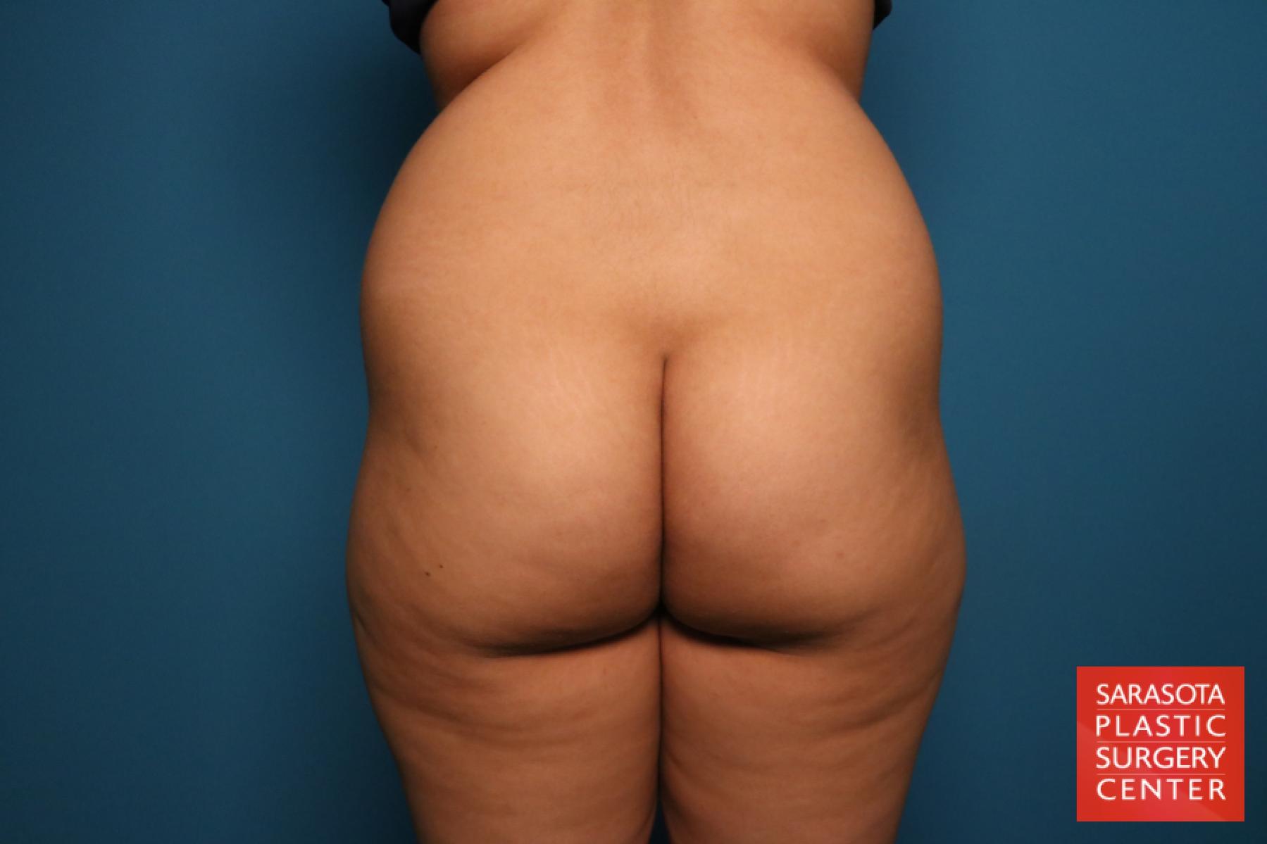 Liposuction: Patient 15 - Before 4