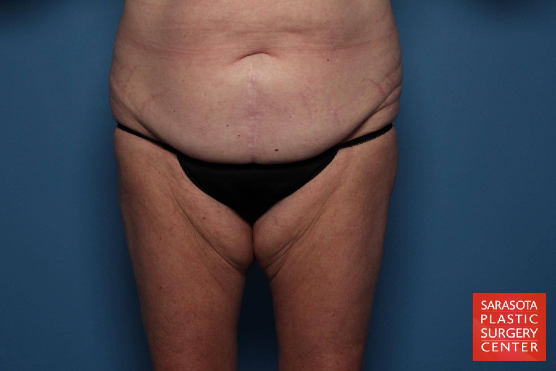 Tummy Tuck: Patient 15 - Before and After 4
