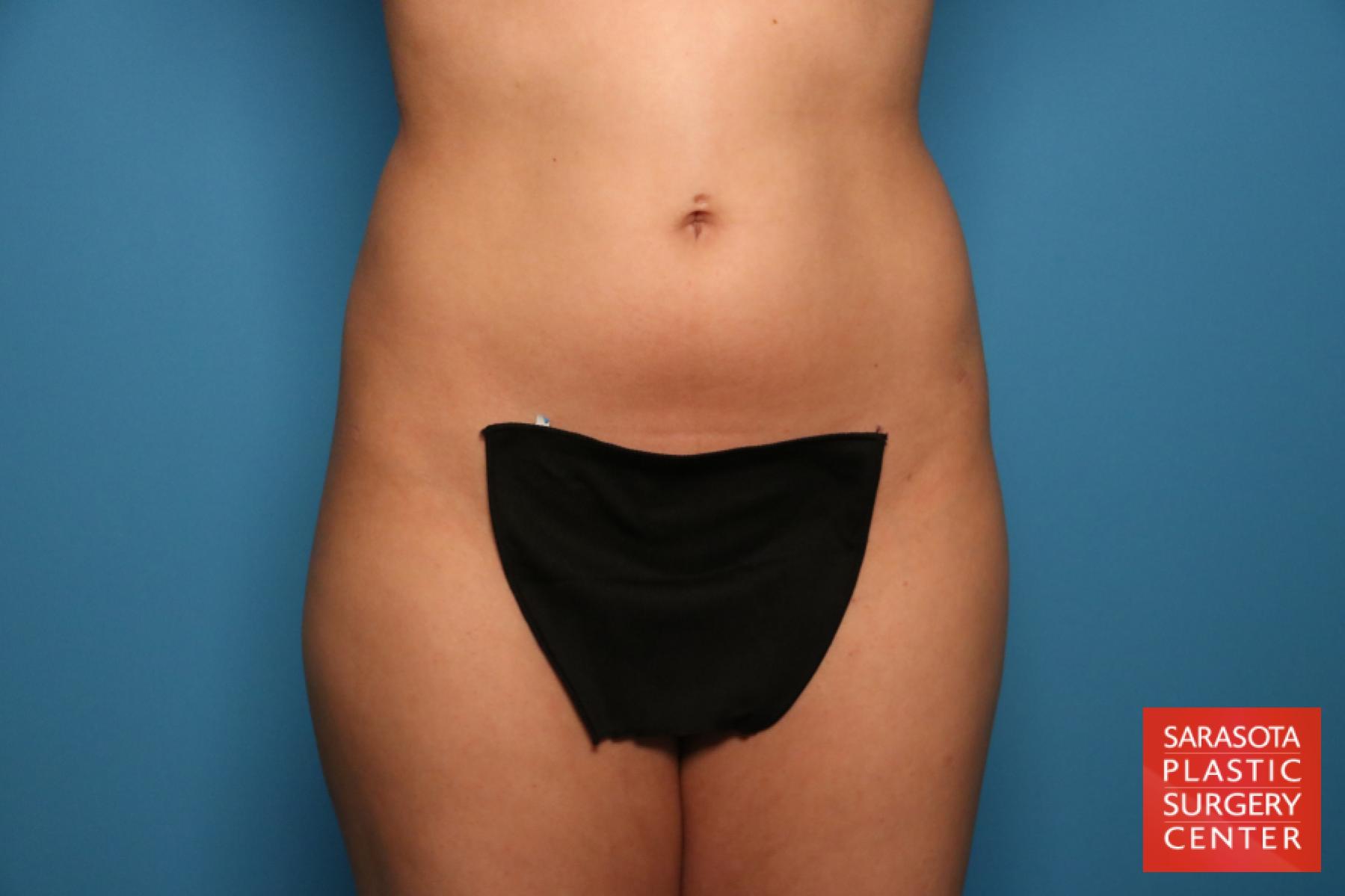 Liposuction: Patient 15 - After 1