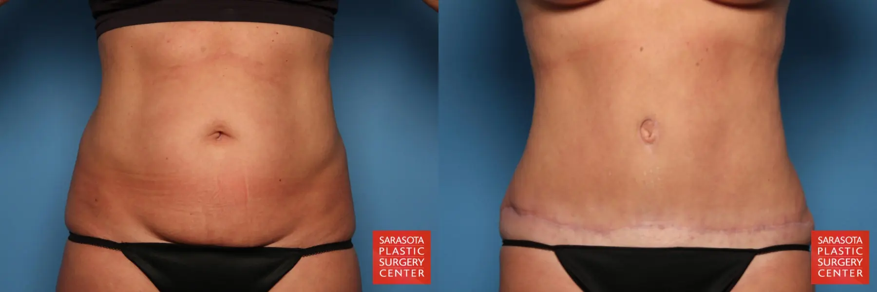 Tummy Tuck: Patient 25 - Before and After 1