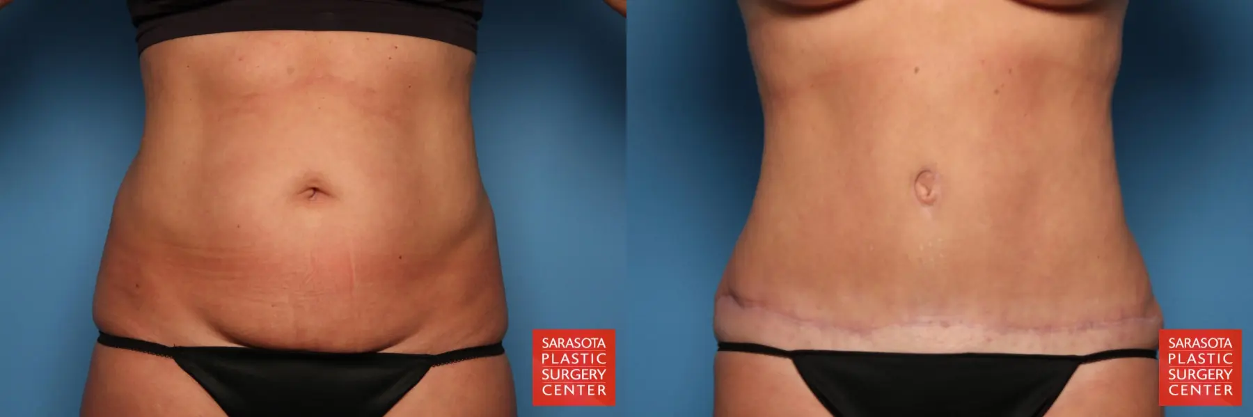 Tummy Tuck: Patient 24 - Before and After  