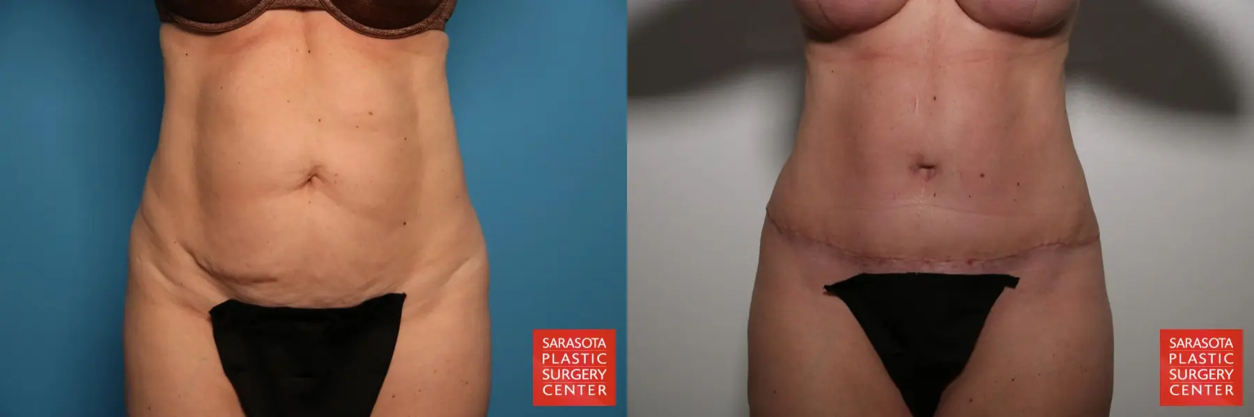 Tummy Tuck: Patient 22 - Before and After  