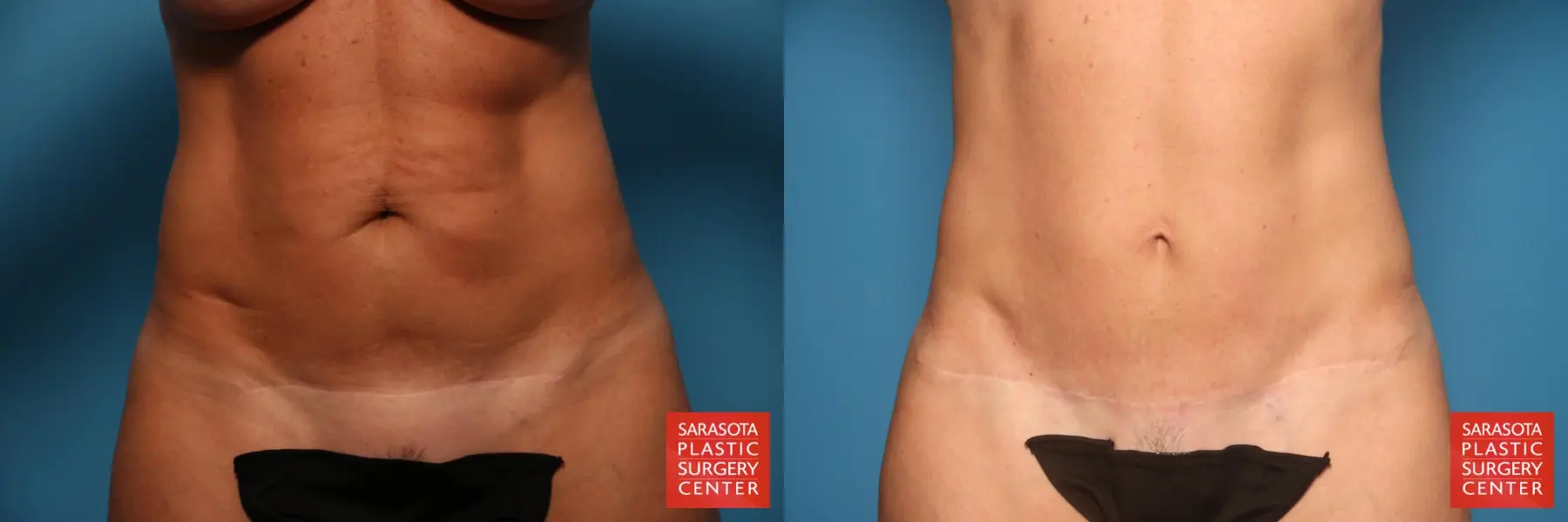 Tummy Tuck: Patient 27 - Before and After  