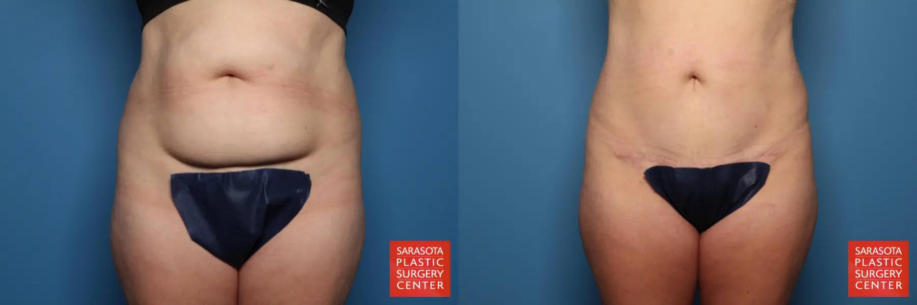 Tummy Tuck: Patient 5 - Before and After  