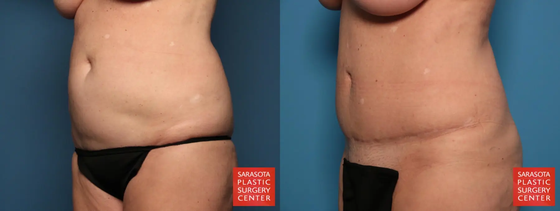 Tummy Tuck: Patient 19 - Before and After 2