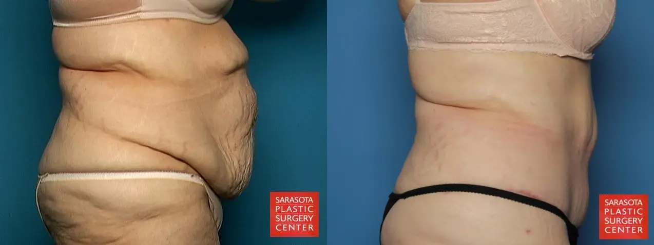 Tummy Tuck: Patient 2 - Before and After 5