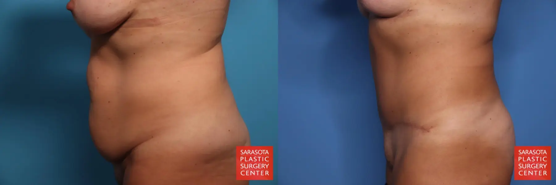 Tummy Tuck: Patient 27 - Before and After 3