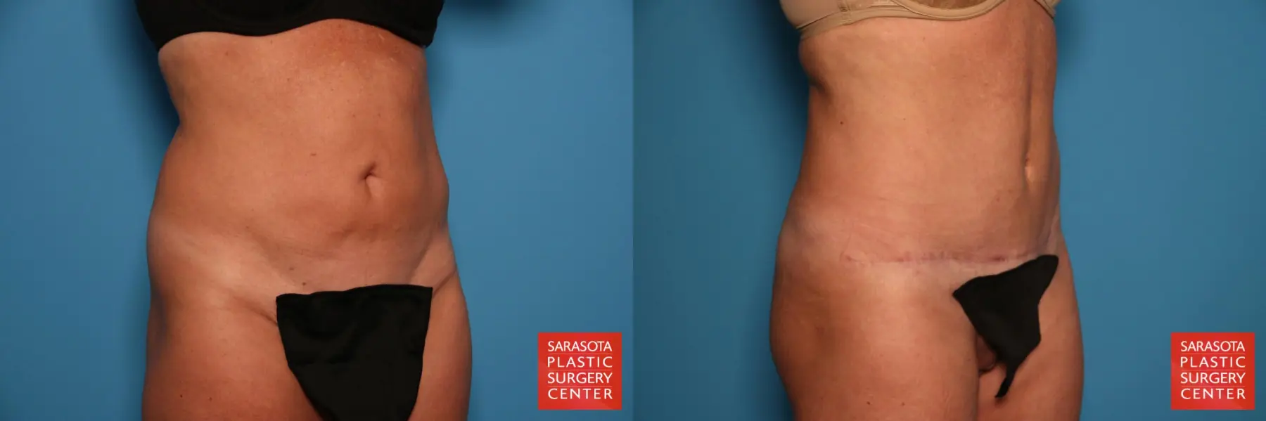 Tummy Tuck: Patient 10 - Before and After 2