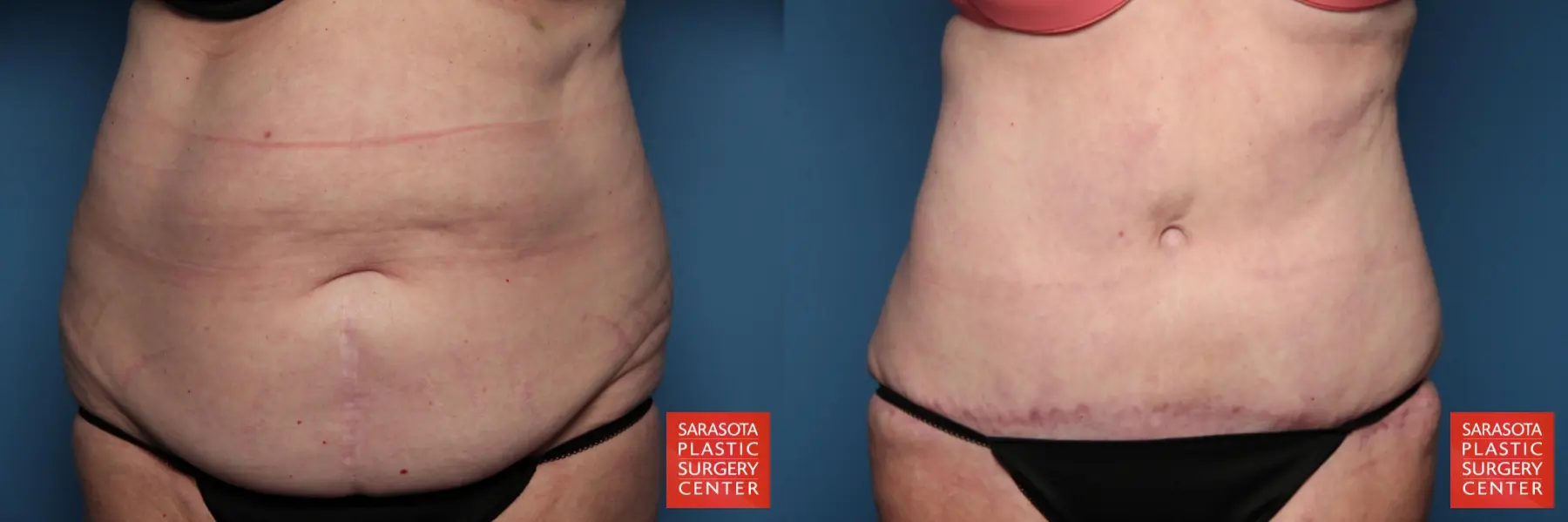 Tummy Tuck: Patient 15 - Before and After 1