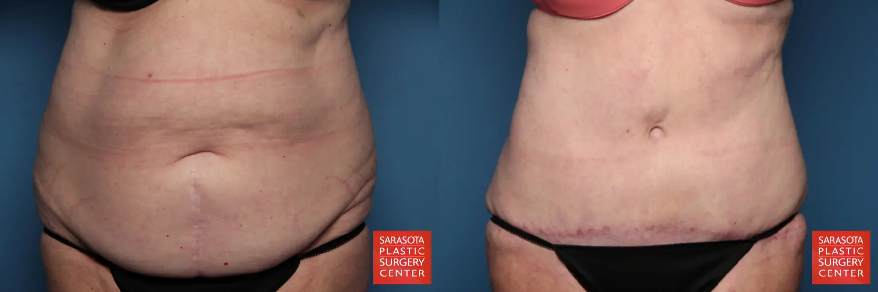 Tummy Tuck: Patient 15 - Before and After  