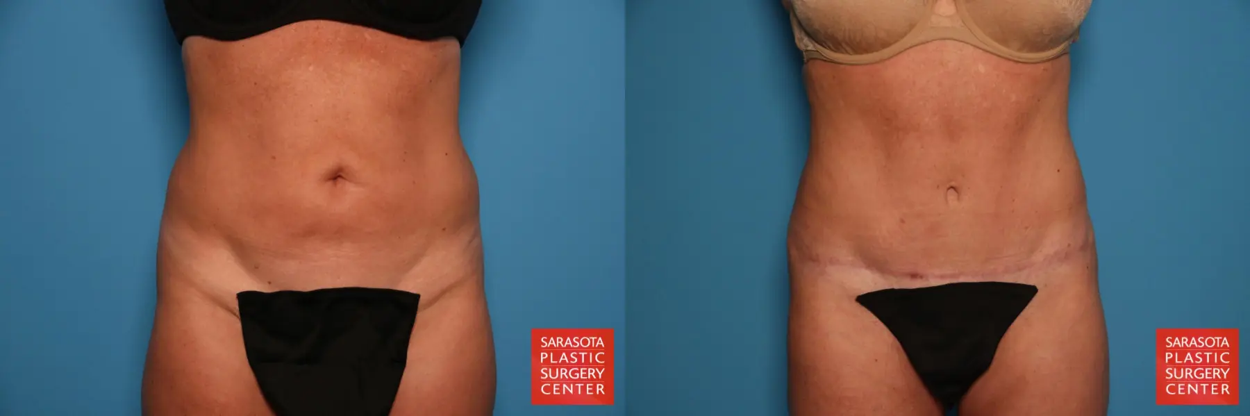 Tummy Tuck: Patient 10 - Before and After 1