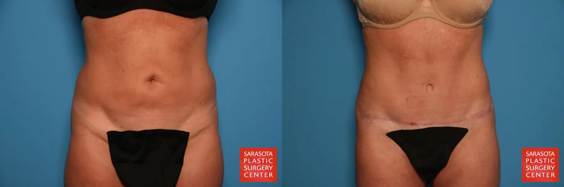 Tummy Tuck: Patient 10 - Before and After  