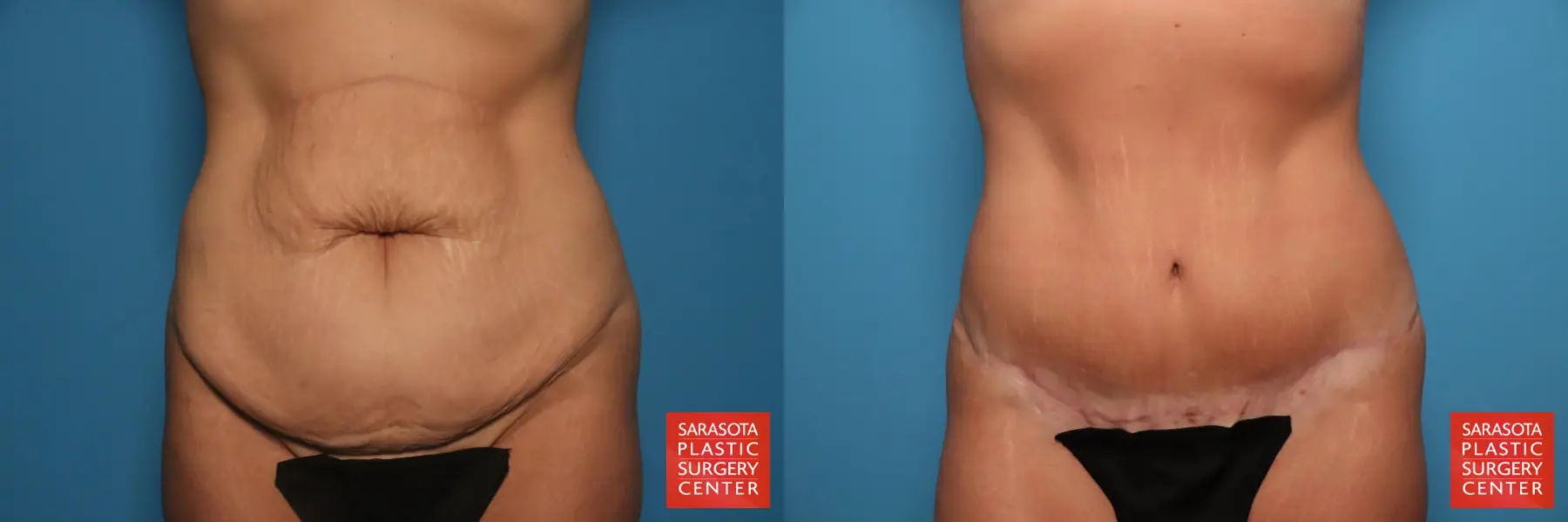 Tummy Tuck: Patient 25 - Before and After  