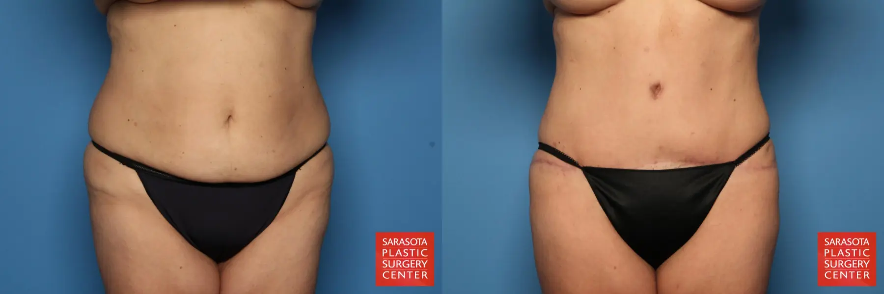 Tummy Tuck: Patient 10 - Before and After  