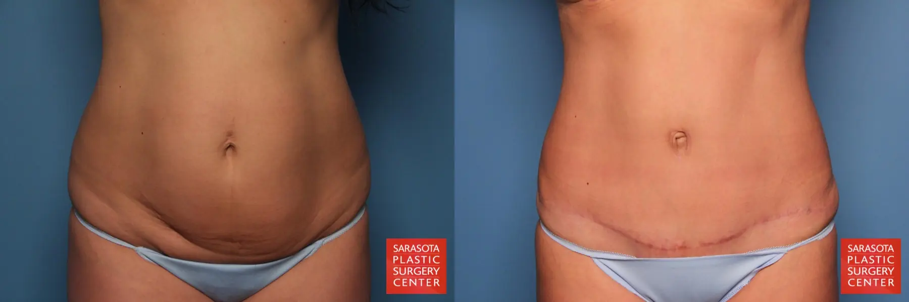 Tummy Tuck: Patient 12 - Before and After  