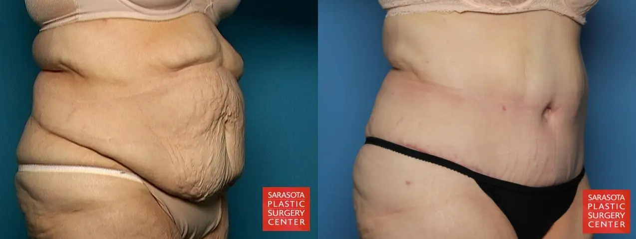 Tummy Tuck: Patient 2 - Before and After 4
