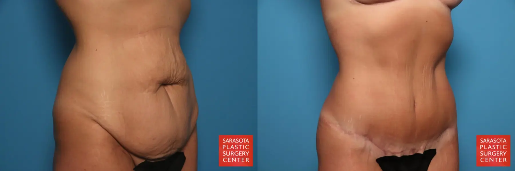 Tummy Tuck: Patient 26 - Before and After 2