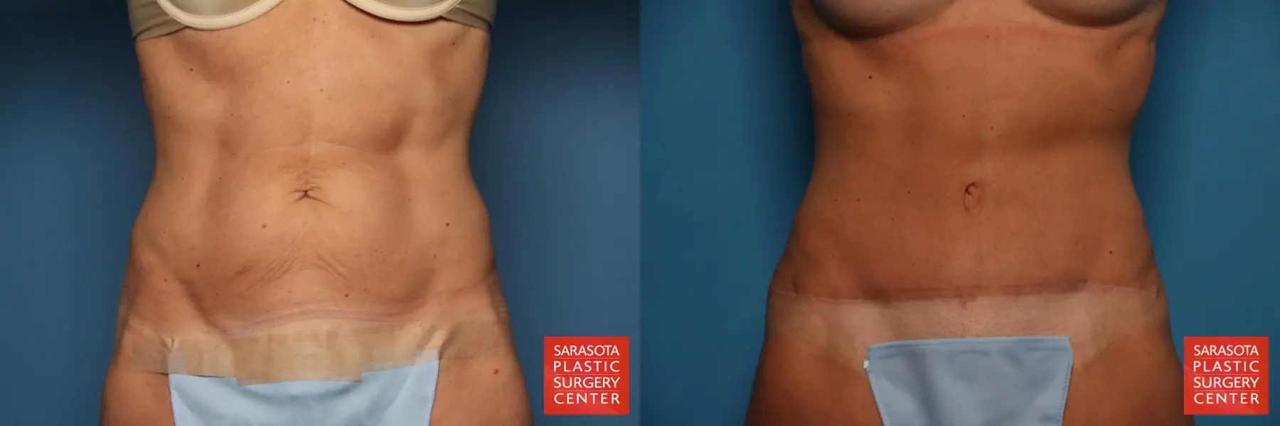Tummy Tuck: Patient 30 - Before and After 1