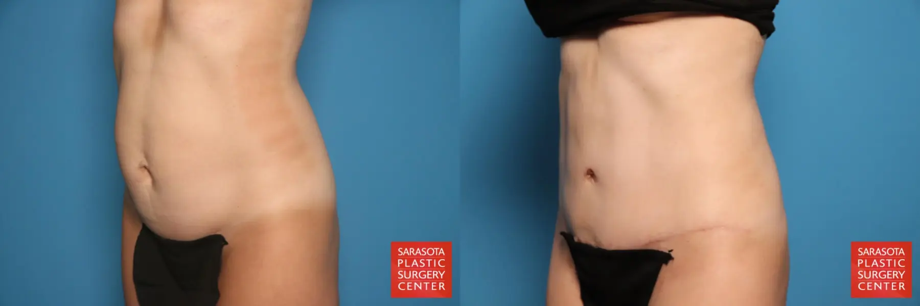 Tummy Tuck: Patient 29 - Before and After 2
